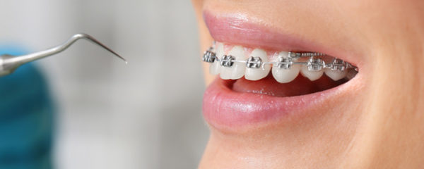 Appareil orthodontique