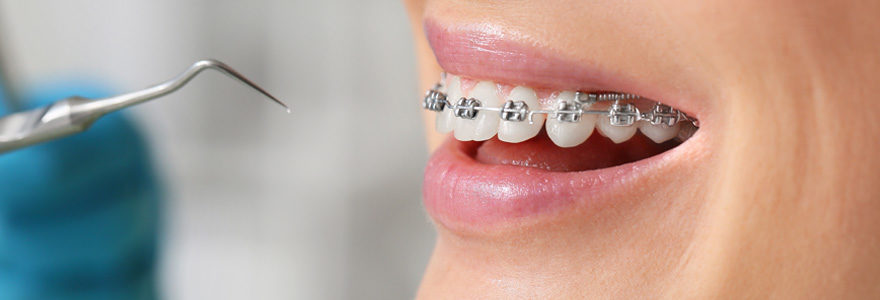 Appareil orthodontique